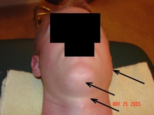 case 3, before treatment